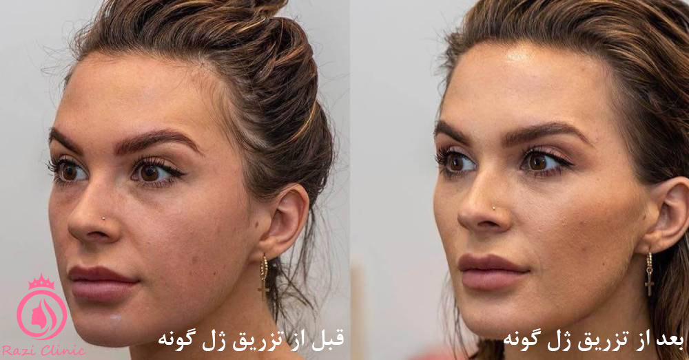 کاربرد تزریق ژل گونه چیست؟