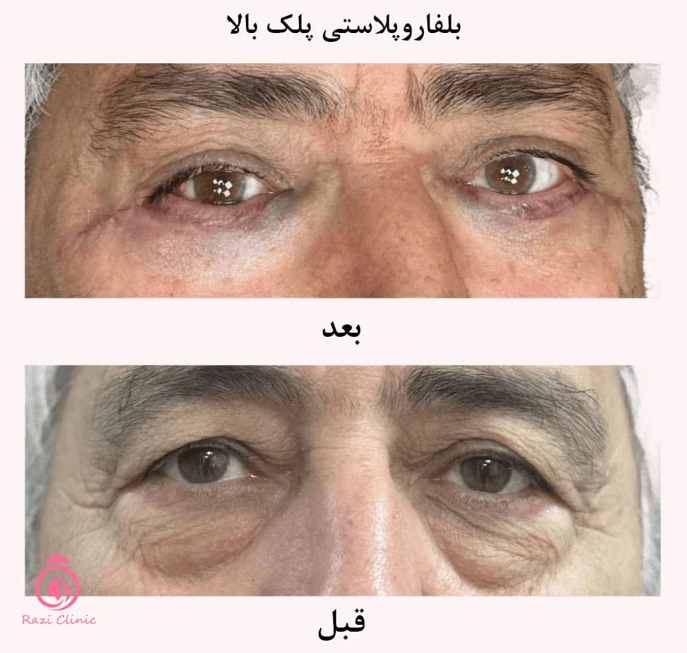 آشنایی با بلفاروپلاستی