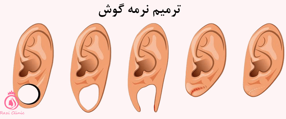 ترمیم و بازسازی نرمه گوش 