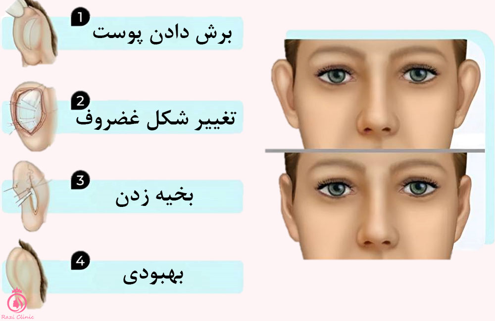 کاهش فاصله گوش‌ها از سر