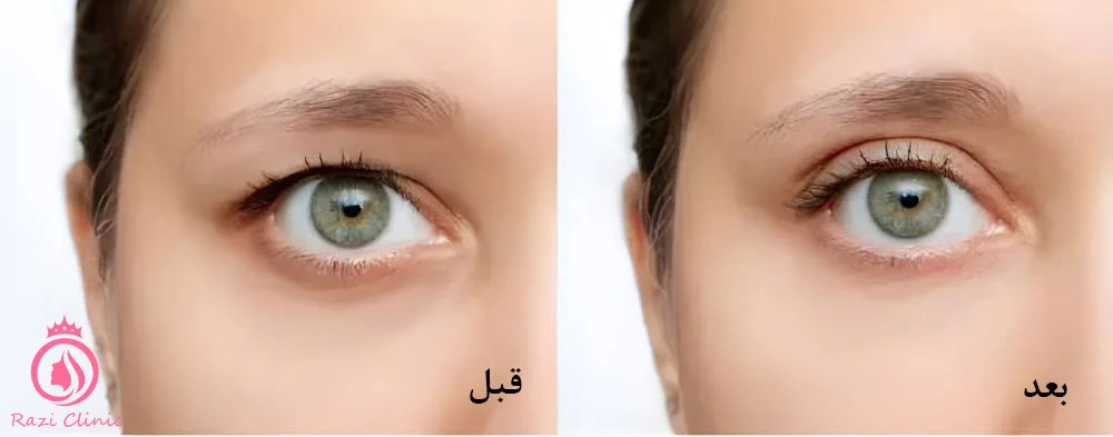 بوتاکس برای برطرف‌کردن افتادگی پلک بالا
