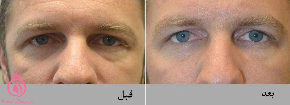 تزریق فیلر برای رفع پف‌کردن پلک پایین