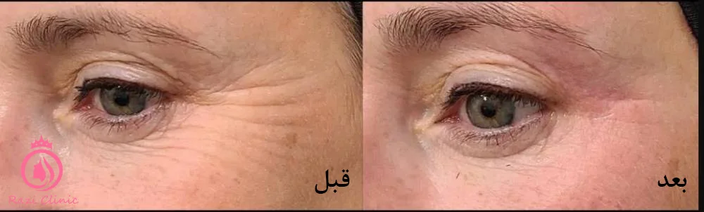 درمان با فرکانس رادیویی برای رفع پف‌کردن پلک پایین