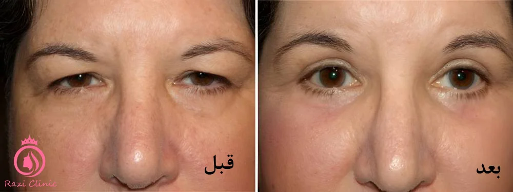 لیزر برای برطرف‌کردن افتادگی پلک بالا