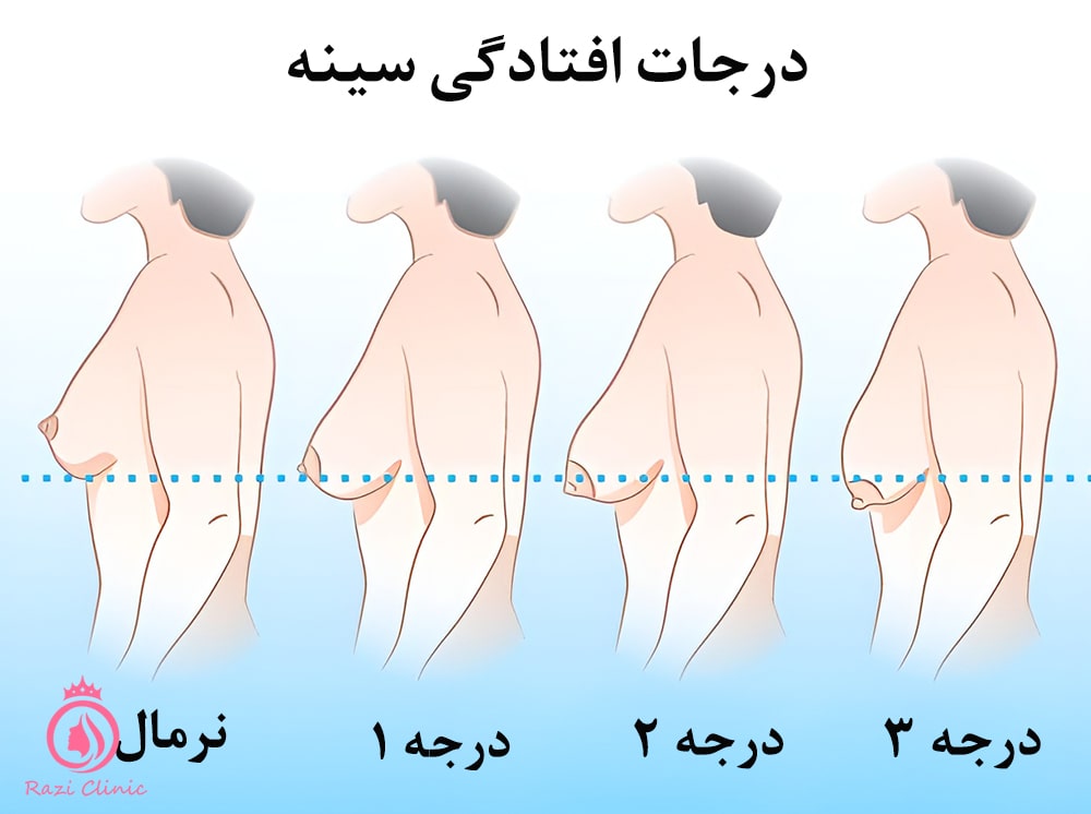افتادگی سینه‌ها (پتوزیس)