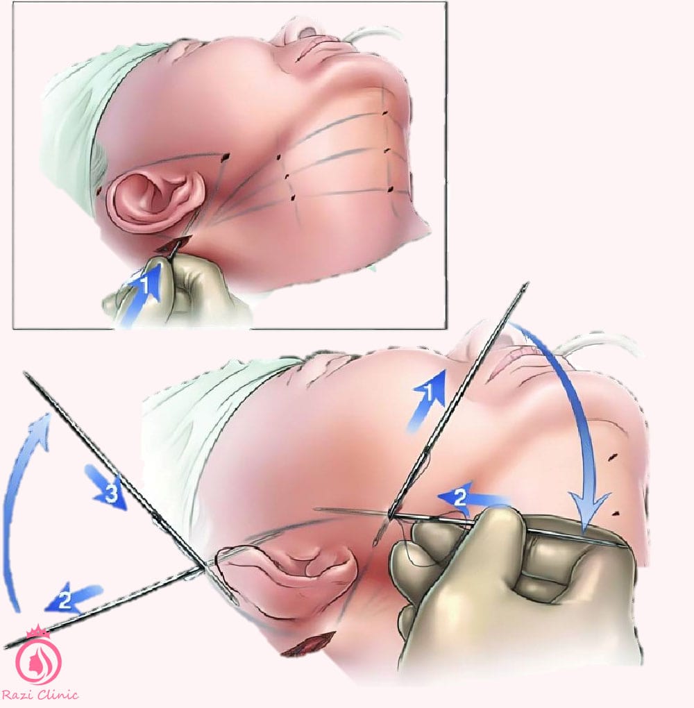 روش لیفت با نخ برای اتوپلاستی